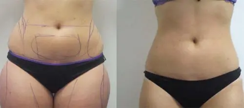 Cavitazione Medica ed Estetica per Rimuovere il Grasso