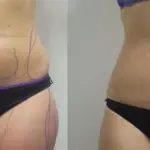 Zerona, eliminare il grasso addominale con il laser