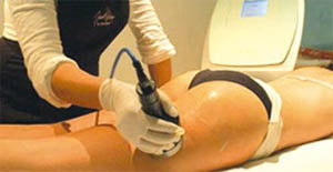 Meglio la liposuzione che i trattamenti con Laser, Cavitazione, Radio Frequenza