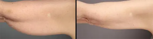 Nuove tecniche di liposuzione, un laser di ultima generazione