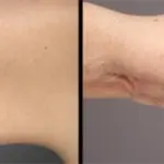 Nuove tecniche di liposuzione, un laser di ultima generazione