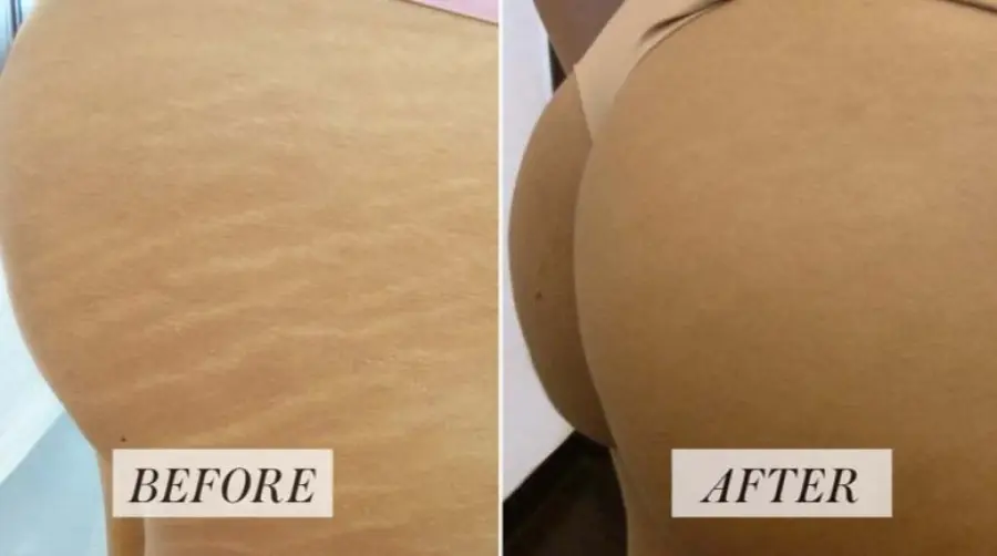 Laser Frazionato per eliminare le Smagliatura come Funziona