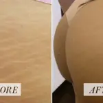 Laser Frazionato per eliminare le Smagliatura come Funziona