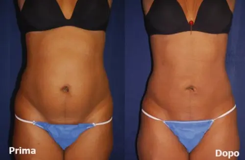 Liposuzione Laser Prezzi e Opinioni Tutto sulla Procedura