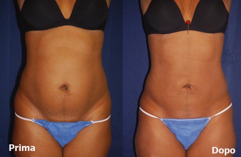 Liposuzione Laser Prezzi e Opinioni Tutto sulla Procedura