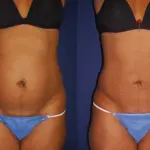 Liposuzione Laser Prezzi e Opinioni Tutto sulla Procedura